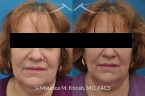 Photo of a patient before and after a procedure. Mole removal from the left upper lip near the nose