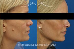 Photo of a patient before and after a procedure. Mole removal from the right cheek