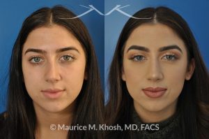 Photo of a patient before and after a procedure. Nose hump removal - 21 year old female wanted a nasal hump removed and the tip of her nose refined. She has breathing obstruction due to a crooked septum. She underwent a closed rhinoplasty and septoplasty. during rhinoplasty, the nasal hump was removed, nasal bones were narrowed, and a columellar strut placed to improve her nasal tip position.