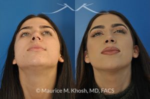Photo of a patient before and after a procedure. Nose hump removal - 21 year old female wanted a nasal hump removed and the tip of her nose refined. She has breathing obstruction due to a crooked septum. She underwent a closed rhinoplasty and septoplasty. during rhinoplasty, the nasal hump was removed, nasal bones were narrowed, and a columellar strut placed to improve her nasal tip position.