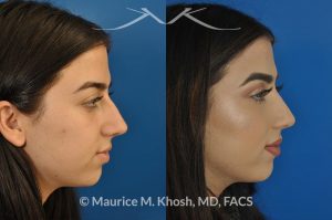 Photo of a patient before and after a procedure. Nose hump removal - 21 year old female wanted a nasal hump removed and the tip of her nose refined. She has breathing obstruction due to a crooked septum. She underwent a closed rhinoplasty and septoplasty. during rhinoplasty, the nasal hump was removed, nasal bones were narrowed, and a columellar strut placed to improve her nasal tip position.