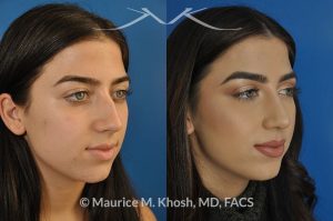 Photo of a patient before and after a procedure. Nose hump removal - 21 year old female wanted a nasal hump removed and the tip of her nose refined. She has breathing obstruction due to a crooked septum. She underwent a closed rhinoplasty and septoplasty. during rhinoplasty, the nasal hump was removed, nasal bones were narrowed, and a columellar strut placed to improve her nasal tip position.