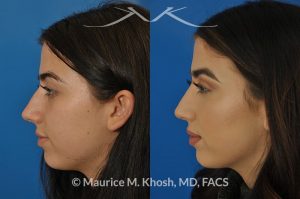 Photo of a patient before and after a procedure. Nose hump removal - 21 year old female wanted a nasal hump removed and the tip of her nose refined. She has breathing obstruction due to a crooked septum. She underwent a closed rhinoplasty and septoplasty. during rhinoplasty, the nasal hump was removed, nasal bones were narrowed, and a columellar strut placed to improve her nasal tip position.