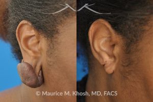 Photo of a patient before and after a procedure. Recurrent keloid of earlobe - Keloid from this earlobe had been previously excised twice. On each occasion, the keloid recurred within a few months. The keloid was surgically removed and post excision Kenalog injections have helped to prevent keloid recurrence. The picture shows one year post operative results.