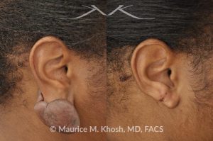 Photo of a patient before and after a procedure. Recurrent keloid of earlobe - Keloid from this earlobe had been previously excised twice. On each occasion, the keloid recurred within a few months. The keloid was surgically removed and post excision Kenalog injections have helped to prevent keloid recurrence. The picture shows one year post operative results.