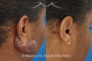 Photo of a patient before and after a procedure. Recurrent keloid of earlobe - Keloid from this earlobe had been previously excised twice. On each occasion, the keloid recurred within a few months. The keloid was surgically removed and post excision Kenalog injections have helped to prevent keloid recurrence. The picture shows one year post operative results.