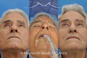 Photo of a patient before and after a procedure. Picture of skin cancer of nose before removal, after Moh's surgery, and following reconstruction - This 69 year old gentleman had Basal Cell Carcinoma of the skin of the right nasal lobule (shown on the left side). The skin cancer was removed via the Mohs technique resulting in near total loss of the right nasal ala (central picture). The nose was reconstructed in a two stage operation utilizing a right nasolabial flap and cartilage graft. The final results are shown on the right side of the picture.