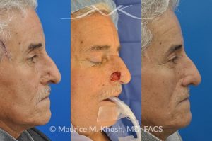 Photo of a patient before and after a procedure. Picture of skin cancer of nose before removal, after Moh's surgery, and following reconstruction - This 69 year old gentleman had Basal Cell Carcinoma of the skin of the right nasal lobule (shown on the left side). The skin cancer was removed via the Mohs technique resulting in near total loss of the right nasal ala (central picture). The nose was reconstructed in a two stage operation utilizing a right nasolabial flap and cartilage graft. The final results are shown on the right side of the picture.