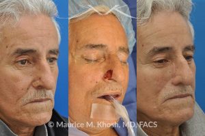 Photo of a patient before and after a procedure. Picture of skin cancer of nose before removal, after Moh's surgery, and following reconstruction - This 69 year old gentleman had Basal Cell Carcinoma of the skin of the right nasal lobule (shown on the left side). The skin cancer was removed via the Mohs technique resulting in near total loss of the right nasal ala (central picture). The nose was reconstructed in a two stage operation utilizing a right nasolabial flap and cartilage graft. The final results are shown on the right side of the picture.
