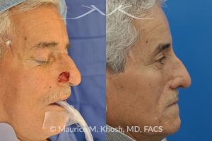 Photo of a patient before and after a procedure. Picture of skin cancer of nose before removal, after Moh's surgery, and following reconstruction - This 69 year old gentleman had Basal Cell Carcinoma of the skin of the right nasal lobule (shown on the left side). The skin cancer was removed via the Mohs technique resulting in near total loss of the right nasal ala (central picture). The nose was reconstructed in a two stage operation utilizing a right nasolabial flap and cartilage graft. The final results are shown on the right side of the picture.