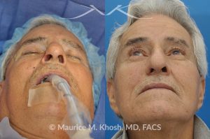 Photo of a patient before and after a procedure. Picture of skin cancer of nose before removal, after Moh's surgery, and following reconstruction - This 69 year old gentleman had Basal Cell Carcinoma of the skin of the right nasal lobule (shown on the left side). The skin cancer was removed via the Mohs technique resulting in near total loss of the right nasal ala (central picture). The nose was reconstructed in a two stage operation utilizing a right nasolabial flap and cartilage graft. The final results are shown on the right side of the picture.