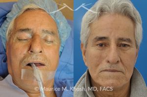 Photo of a patient before and after a procedure. Picture of skin cancer of nose before removal, after Moh's surgery, and following reconstruction - This 69 year old gentleman had Basal Cell Carcinoma of the skin of the right nasal lobule (shown on the left side). The skin cancer was removed via the Mohs technique resulting in near total loss of the right nasal ala (central picture). The nose was reconstructed in a two stage operation utilizing a right nasolabial flap and cartilage graft. The final results are shown on the right side of the picture.