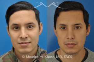 Photo of a patient before and after a procedure. Revision rhinoplasty to improve breathing and refine the tip - This 31 year old had previously undergone a nose job operation at age 17. He had breathing difficulty from both sides of the nose. He also disliked the flat, wide, asymmetric, and under-projected appearance of the tip of the nose. Revision rhinoplasty was performed to restore breathing and improve the appearance of the tip of the nose. Open approach rhinopalsty was used to place bilateral spreader grafts, left alar strut graft, narrow the tip, and improve the projection of the tip of the nose.