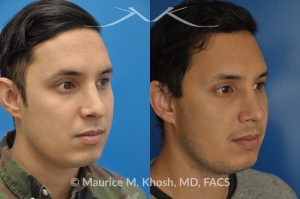 Photo of a patient before and after a procedure. Revision rhinoplasty to improve breathing and refine the tip - This 31 year old had previously undergone a nose job operation at age 17. He had breathing difficulty from both sides of the nose. He also disliked the flat, wide, asymmetric, and under-projected appearance of the tip of the nose. Revision rhinoplasty was performed to restore breathing and improve the appearance of the tip of the nose. Open approach rhinopalsty was used to place bilateral spreader grafts, left alar strut graft, narrow the tip, and improve the projection of the tip of the nose.