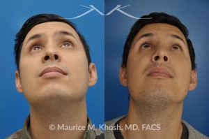 Photo of a patient before and after a procedure. Revision rhinoplasty to improve breathing and refine the tip - This 31 year old had previously undergone a nose job operation at age 17. He had breathing difficulty from both sides of the nose. He also disliked the flat, wide, asymmetric, and under-projected appearance of the tip of the nose. Revision rhinoplasty was performed to restore breathing and improve the appearance of the tip of the nose. Open approach rhinopalsty was used to place bilateral spreader grafts, left alar strut graft, narrow the tip, and improve the projection of the tip of the nose.