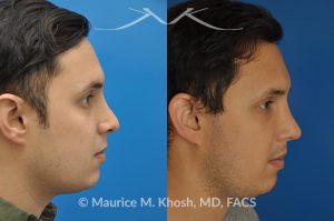 Photo of a patient before and after a procedure. Revision rhinoplasty to improve breathing and refine the tip - This 31 year old had previously undergone a nose job operation at age 17. He had breathing difficulty from both sides of the nose. He also disliked the flat, wide, asymmetric, and under-projected appearance of the tip of the nose. Revision rhinoplasty was performed to restore breathing and improve the appearance of the tip of the nose. Open approach rhinopalsty was used to place bilateral spreader grafts, left alar strut graft, narrow the tip, and improve the projection of the tip of the nose.
