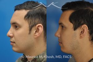 Photo of a patient before and after a procedure. Revision rhinoplasty to improve breathing and refine the tip - This 31 year old had previously undergone a nose job operation at age 17. He had breathing difficulty from both sides of the nose. He also disliked the flat, wide, asymmetric, and under-projected appearance of the tip of the nose. Revision rhinoplasty was performed to restore breathing and improve the appearance of the tip of the nose. Open approach rhinopalsty was used to place bilateral spreader grafts, left alar strut graft, narrow the tip, and improve the projection of the tip of the nose.