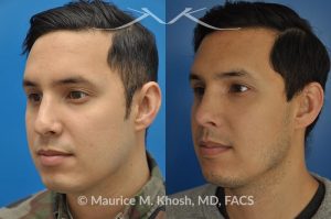 Photo of a patient before and after a procedure. Revision rhinoplasty to improve breathing and refine the tip - This 31 year old had previously undergone a nose job operation at age 17. He had breathing difficulty from both sides of the nose. He also disliked the flat, wide, asymmetric, and under-projected appearance of the tip of the nose. Revision rhinoplasty was performed to restore breathing and improve the appearance of the tip of the nose. Open approach rhinopalsty was used to place bilateral spreader grafts, left alar strut graft, narrow the tip, and improve the projection of the tip of the nose.
