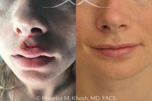 Photo of a patient before and after a procedure. Torn upper lip repair - This 25 year old suffered an upper lip laceration due to a surfing accident. She had repair of the laceration locally in Central America, but had to undergo revision of the repair when she returned to New York. The photograph is three months after the repair.