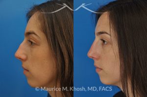 Photo of a patient before and after a procedure. Rhinoplasty to remove hump and improve breathing - This young lady in her twenties co breathing difficulty and a nasal bony hump. She underwent rhinoplasty through an endo-nasal or closed approach. He nasal hump was removed. She also had cartilage grafts (right sided spreader graft and bilateral alar strut grafts) to support her nasal valve patency.