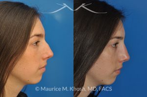 Photo of a patient before and after a procedure. Rhinoplasty to remove hump and improve breathing - This young lady in her twenties co breathing difficulty and a nasal bony hump. She underwent rhinoplasty through an endo-nasal or closed approach. He nasal hump was removed. She also had cartilage grafts (right sided spreader graft and bilateral alar strut grafts) to support her nasal valve patency.