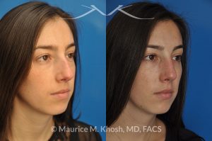 Photo of a patient before and after a procedure. Rhinoplasty to remove hump and improve breathing - This young lady in her twenties co breathing difficulty and a nasal bony hump. She underwent rhinoplasty through an endo-nasal or closed approach. He nasal hump was removed. She also had cartilage grafts (right sided spreader graft and bilateral alar strut grafts) to support her nasal valve patency.