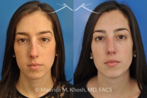 Photo of a patient before and after a procedure. Rhinoplasty to remove hump and improve breathing - This young lady in her twenties co breathing difficulty and a nasal bony hump. She underwent rhinoplasty through an endo-nasal or closed approach. He nasal hump was removed. She also had cartilage grafts (right sided spreader graft and bilateral alar strut grafts) to support her nasal valve patency.