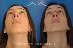 Photo of a patient before and after a procedure. Rhinoplasty to remove hump and improve breathing - This young lady in her twenties co breathing difficulty and a nasal bony hump. She underwent rhinoplasty through an endo-nasal or closed approach. He nasal hump was removed. She also had cartilage grafts (right sided spreader graft and bilateral alar strut grafts) to support her nasal valve patency.