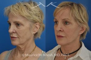 Photo of a patient before and after a procedure. Facelift, neck lift, temporal brow lift - 65 years old lady interested in improving her sagging neck, eliminating her jowls, and elevating the droopy eyebrow position. She underwent SMAS facelift, neck lift, and temporal brow lift.