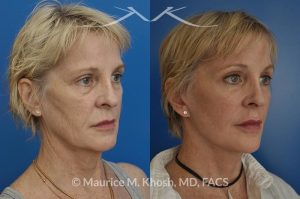 Photo of a patient before and after a procedure. Facelift, neck lift, temporal brow lift - 65 years old lady interested in improving her sagging neck, eliminating her jowls, and elevating the droopy eyebrow position. She underwent SMAS facelift, neck lift, and temporal brow lift.