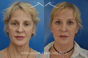 Photo of a patient before and after a procedure. Facelift, neck lift, temporal brow lift - 65 years old lady interested in improving her sagging neck, eliminating her jowls, and elevating the droopy eyebrow position. She underwent SMAS facelift, neck lift, and temporal brow lift.