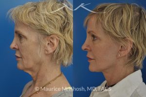 Photo of a patient before and after a procedure. Facelift, neck lift, temporal brow lift - 65 years old lady interested in improving her sagging neck, eliminating her jowls, and elevating the droopy eyebrow position. She underwent SMAS facelift, neck lift, and temporal brow lift.