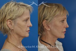 Photo of a patient before and after a procedure. Facelift, neck lift, temporal brow lift - 65 years old lady interested in improving her sagging neck, eliminating her jowls, and elevating the droopy eyebrow position. She underwent SMAS facelift, neck lift, and temporal brow lift.