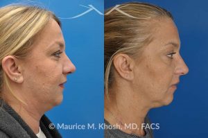 Photo of a patient before and after a procedure. Kybella - A 52 year old looking for non surgical treatment of her excess neck fat and double chin. She did not wish to have neck liposuction and preferred Kybella injections in New York City to dissolve the neck fat.