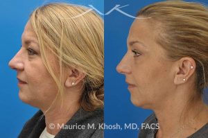 Photo of a patient before and after a procedure. Kybella - A 52 year old looking for non surgical treatment of her excess neck fat and double chin. She did not wish to have neck liposuction and preferred Kybella injections in New York City to dissolve the neck fat.