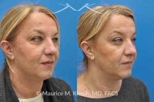 Photo of a patient before and after a procedure. Kybella - A 52 year old looking for non surgical treatment of her excess neck fat and double chin. She did not wish to have neck liposuction and preferred Kybella injections in New York City to dissolve the neck fat.