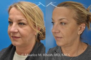 Photo of a patient before and after a procedure. Kybella - A 52 year old looking for non surgical treatment of her excess neck fat and double chin. She did not wish to have neck liposuction and preferred Kybella injections in New York City to dissolve the neck fat.