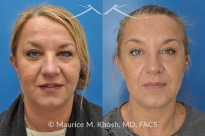 Photo of a patient before and after a procedure. Kybella - A 52 year old looking for non surgical treatment of her excess neck fat and double chin. She did not wish to have neck liposuction and preferred Kybella injections in New York City to dissolve the neck fat.