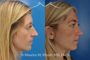 Photo of a patient before and after a procedure. Nose job for a narrow and long nose - his 26 year old was interested in nose job in New York, in order to reduce her nasal hump, and make the nasal tip shorter and more refined. She underwent an open approach rhinoplasty which included shortening of the septum, removing the medial crura foot plates, and narrowing the nostrils.