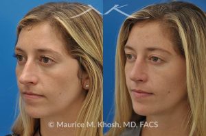 Photo of a patient before and after a procedure. Nose job for a narrow and long nose - his 26 year old was interested in nose job in New York, in order to reduce her nasal hump, and make the nasal tip shorter and more refined. She underwent an open approach rhinoplasty which included shortening of the septum, removing the medial crura foot plates, and narrowing the nostrils.