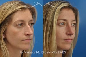 Photo of a patient before and after a procedure. Nose job for a narrow and long nose - his 26 year old was interested in nose job in New York, in order to reduce her nasal hump, and make the nasal tip shorter and more refined. She underwent an open approach rhinoplasty which included shortening of the septum, removing the medial crura foot plates, and narrowing the nostrils.