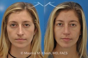 Photo of a patient before and after a procedure. Nose job for a narrow and long nose - his 26 year old was interested in nose job in New York, in order to reduce her nasal hump, and make the nasal tip shorter and more refined. She underwent an open approach rhinoplasty which included shortening of the septum, removing the medial crura foot plates, and narrowing the nostrils.