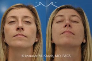 Photo of a patient before and after a procedure. Nose job for a narrow and long nose - his 26 year old was interested in nose job in New York, in order to reduce her nasal hump, and make the nasal tip shorter and more refined. She underwent an open approach rhinoplasty which included shortening of the septum, removing the medial crura foot plates, and narrowing the nostrils.