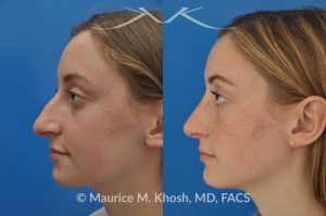 Photo of a patient before and after a procedure. Nose job to refine and elevate tip and reduce a hump - This 19 year old wanted rhinoplasty in New York City to address a droopy nasal tip, and a nasal hump. She disliked the movement of the tip of her nose when she smiled. She was treated with open rhinoplasty which allowed dorsal reduction, bilateral cartilage spreader grafts and alar rim grafts (to maintain breathing), and tip narrowing.