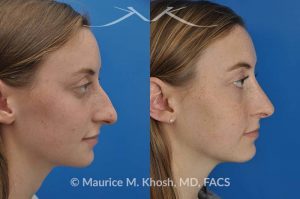 Photo of a patient before and after a procedure. Nose job to refine and elevate tip and reduce a hump - This 19 year old wanted rhinoplasty in New York City to address a droopy nasal tip, and a nasal hump. She disliked the movement of the tip of her nose when she smiled. She was treated with open rhinoplasty which allowed dorsal reduction, bilateral cartilage spreader grafts and alar rim grafts (to maintain breathing), and tip narrowing.