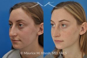 Photo of a patient before and after a procedure. Nose job to refine and elevate tip and reduce a hump - This 19 year old wanted rhinoplasty in New York City to address a droopy nasal tip, and a nasal hump. She disliked the movement of the tip of her nose when she smiled. She was treated with open rhinoplasty which allowed dorsal reduction, bilateral cartilage spreader grafts and alar rim grafts (to maintain breathing), and tip narrowing.