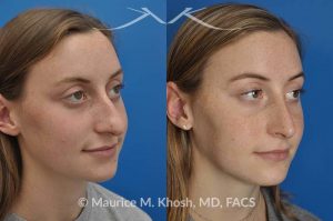 Photo of a patient before and after a procedure. Nose job to refine and elevate tip and reduce a hump - This 19 year old wanted rhinoplasty in New York City to address a droopy nasal tip, and a nasal hump. She disliked the movement of the tip of her nose when she smiled. She was treated with open rhinoplasty which allowed dorsal reduction, bilateral cartilage spreader grafts and alar rim grafts (to maintain breathing), and tip narrowing.