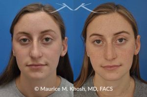 Photo of a patient before and after a procedure. Nose job to refine and elevate tip and reduce a hump - This 19 year old wanted rhinoplasty in New York City to address a droopy nasal tip, and a nasal hump. She disliked the movement of the tip of her nose when she smiled. She was treated with open rhinoplasty which allowed dorsal reduction, bilateral cartilage spreader grafts and alar rim grafts (to maintain breathing), and tip narrowing.