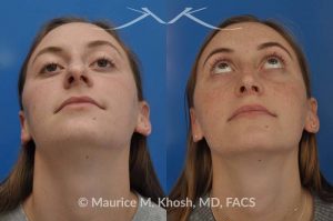 Photo of a patient before and after a procedure. Nose job to refine and elevate tip and reduce a hump - This 19 year old wanted rhinoplasty in New York City to address a droopy nasal tip, and a nasal hump. She disliked the movement of the tip of her nose when she smiled. She was treated with open rhinoplasty which allowed dorsal reduction, bilateral cartilage spreader grafts and alar rim grafts (to maintain breathing), and tip narrowing.