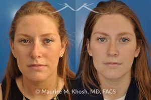 Photo of a patient before and after a procedure. Rhinoplasty for crooked nose - 26 year old with crooked nose to the right side and a small hump. She was seeking rhinoplasty in Manhattan to straighten the nose remove a hump. She was treated with closed rhinoplasty which allowed reduction of the hump, a cartilage spreader graft on the left side, and a columellar strut.